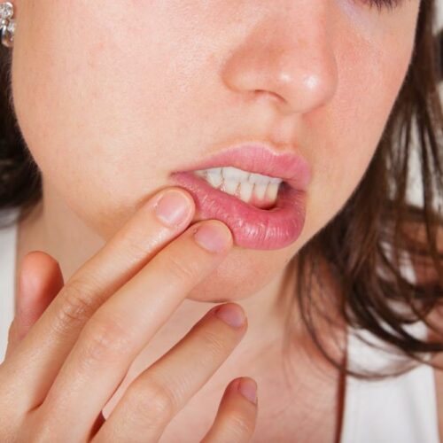 Sposoby leczenia poparzonego języka i ust
